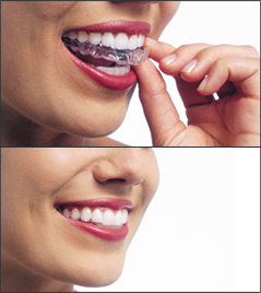 Invisalign Removable Applicance